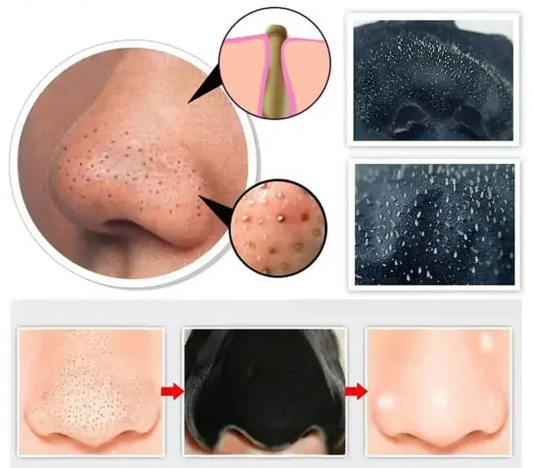 BLACK MASK - čierna maska pre čistú pleť